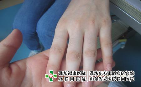 濰坊得了牛皮癬怎么辦?濰坊哪所牛皮癬醫院好 濰坊得了牛皮癬怎么辦?濰坊哪所牛皮癬醫院好