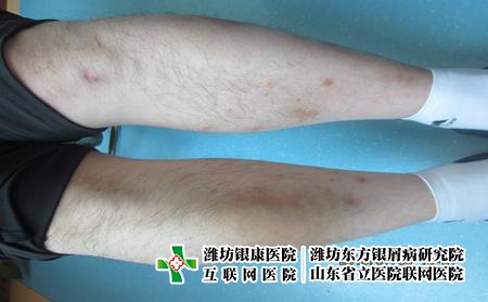 濰坊地區(qū)哪家醫(yī)院牛皮癬看的好，濰坊治療銀屑病專科好評(píng)東方