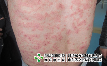 牛皮癬初期是什么樣?牛皮癬初期是什么樣圖片 牛皮癬初期是什么樣?牛皮癬初期是什么樣圖片