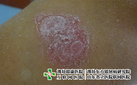 牛皮癬初期是什么樣?牛皮癬初期是什么樣圖片 牛皮癬初期是什么樣?牛皮癬初期是什么樣圖片