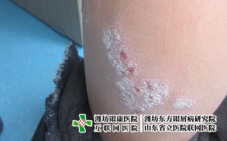 濰坊牛皮癬治療時必須注意的事項?濰坊治銀屑病去哪家好些