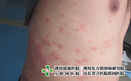 尋常型牛皮癬久治不好的原因?濰坊有專治牛皮癬的醫院嗎 尋常型牛皮癬久治不好的原因?濰坊有專治牛皮癬的醫院嗎