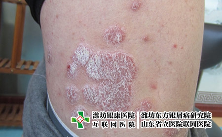 牛皮癬患者的飲食怎么安排?濰坊哪里看牛皮癬病專業(yè)