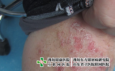 三因素誘發兒童牛皮癬，濰坊牛皮癬醫院看牛皮癬好嗎