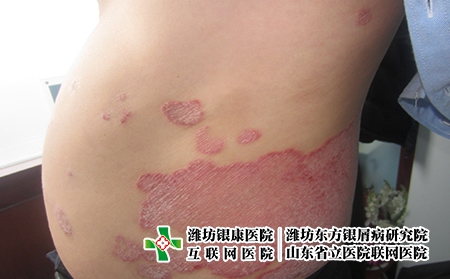 濰坊牛皮癬怎么診斷呢?濰坊地區哪家醫院牛皮癬好