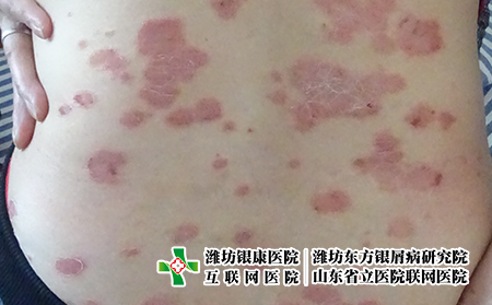 濰坊哪家醫院治療牛皮癬治得好，濰坊銀屑病醫院東方美譽