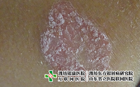 濰坊如何用外擦藥物治療牛皮癬?濰坊那里治牛皮癬較專業