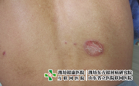 濰坊牛皮癬用什么才能治好?濰坊牛皮癬專科醫(yī)院 濰坊牛皮癬用什么才能治好?濰坊牛皮癬專科醫(yī)院