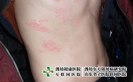 濰坊治療牛皮癬的醫院好不好?濰坊治療銀屑病專科清楚東方