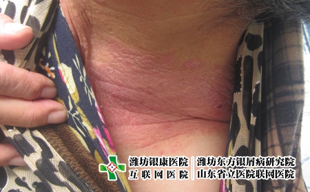 濰坊牛皮癬一直擴散怎么辦?濰坊正規牛皮癬醫院
