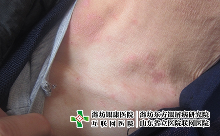 濰坊牛皮癬晚期的癥狀?濰坊治療牛皮癬地址