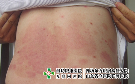 濰坊哪家醫院治療牛皮癬好?濰坊銀屑病研究院好不好