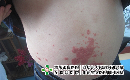 濰坊牛皮癬治療的誤區?濰坊較好的牛皮癬醫院在哪里