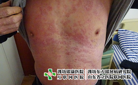 濰坊青少年怎么會(huì)得牛皮癬?濰坊牛皮癬?？漆t(yī)院哪家好一點(diǎn)