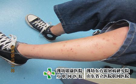 濰坊哪里看牛皮癬比較好?聊城銀屑病合理濰坊東方