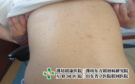 濰坊牛皮癬怎么辦?濰坊好的牛皮癬專科醫(yī)院 濰坊牛皮癬怎么辦?濰坊好的牛皮癬專科醫(yī)院