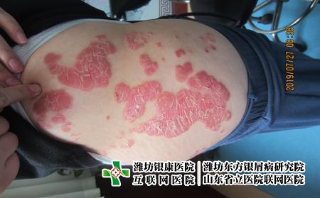 濰坊選哪家醫院治療牛皮癬呢?濰坊那個醫院治療牛皮癬有名