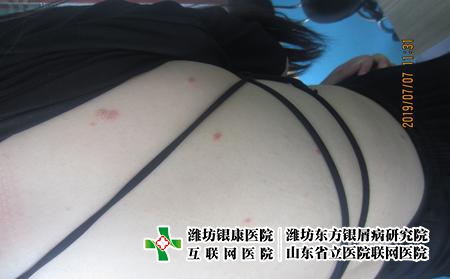 濰坊得了牛皮癬怎么選醫院?濰坊能夠治療牛皮癬的醫院