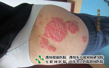 濰坊治療牛皮癬的醫院哪家好?濰坊治療銀屑病管不管
