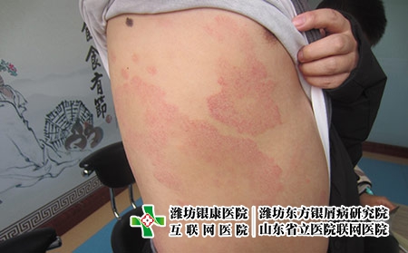 濰坊牛皮癬患者吃油炸食品的危害?濰坊市銀屑病專科來可行東方 濰坊牛皮癬患者吃油炸食品的危害?濰坊市銀屑病專科來可行東方