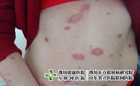 濰坊哪的牛皮癬醫(yī)院好，濰坊最好銀屑病專科推舉東方