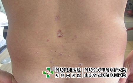 濰坊牛皮癬是怎么回事?濰坊那家醫(yī)院治牛皮癬效果好