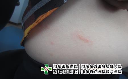 濰坊有點滴狀牛皮癬怎么辦，濰坊銀屑病研究院好不好