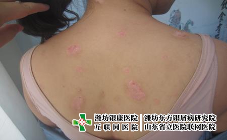 濰坊牛皮癬的護理方法是什么，菏澤銀屑病信賴濰坊李華杰