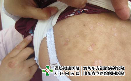 濰坊醫院治療牛皮癬大概需要花費多少錢，青島銀屑病贊美濰坊東方
