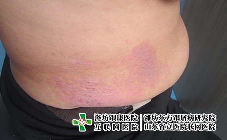 濰坊看牛皮癬醫院到哪好