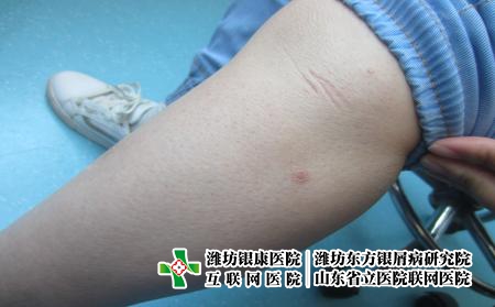 濰坊治療牛皮癬費用要多少呢，濰坊治牛皮癬貴不貴