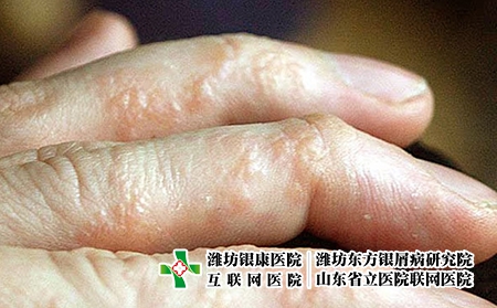 汗皰疹怎么治療除根-汗皰疹用什么藥-汗皰疹怎么治