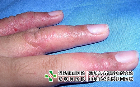 汗皰疹圖片-汗皰疹的癥狀圖片-汗皰疹圖片大全