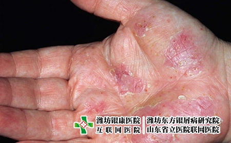 為什么會長汗皰疹-汗皰疹是濕疹嗎-汗皰疹是怎么回事