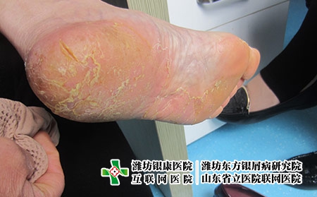 治療掌跖膿皰病-如何治療掌跖膿皰病-掌跖膿皰病用藥