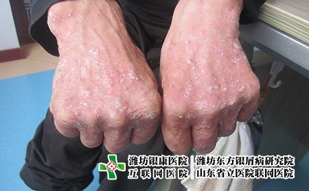 如何治療掌跖膿皰病-掌跖膿皰病治療偏方-掌跖膿皰病治療方法