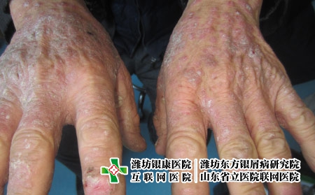 掌跖膿皰病什么引起的-掌跖膿皰病是由什么引起的-掌跖膿皰病怎么引起