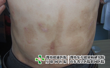 濰坊不同部位的牛皮癬會有怎樣的表現，牛皮癬是什么樣的