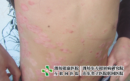 濰坊中醫治療牛皮癬去哪個醫院好，中醫治牛皮癬怎么樣