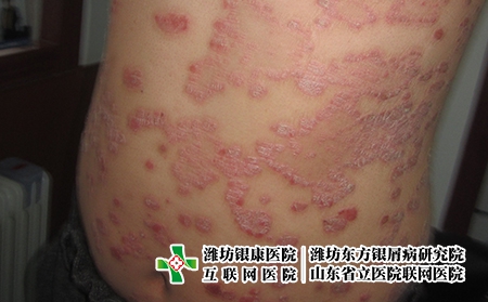 濰坊女性患牛皮癬的原因是什么，女性為什么會得牛皮癬