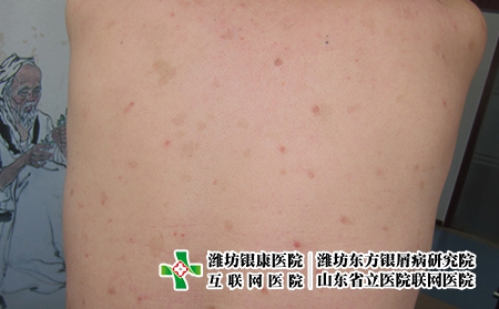 濰坊治療牛皮癬不錯的醫院，濰坊牛皮癬醫院哪個好