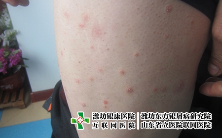 濰坊有牛皮癬還能好嗎，濰坊牛皮癬怎么辦