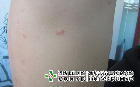 濰坊看牛皮癬哪個醫院好，濰坊牛皮癬醫院怎么樣