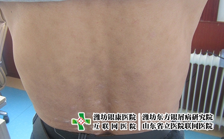 濰坊膿皰型牛皮癬怎么治？膿包型牛皮癬怎么辦