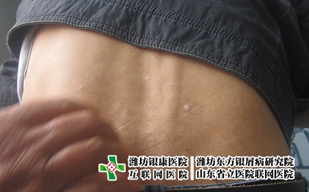 濰坊怎樣及時發現牛皮癬的癥狀，牛皮癬剛開始什么樣