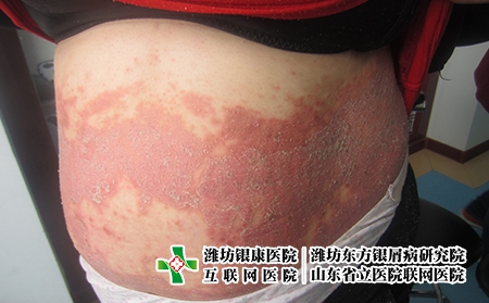 濰坊牛皮癬患者冬季家常菜？牛皮癬冬季怎么食補