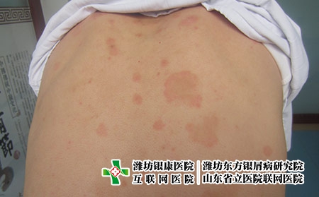 濰坊牛皮癬怎樣有效治療，牛皮癬怎么治管用