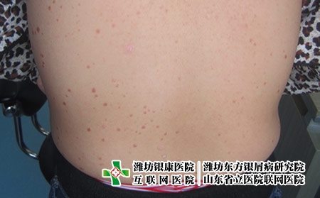 濰坊手部牛皮癬要避免接觸過敏源嗎?過敏會加重牛皮癬嗎