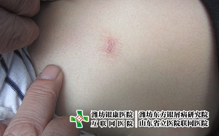 濰坊牛皮癬治療儀效果怎么樣?儀器能治牛皮癬嗎