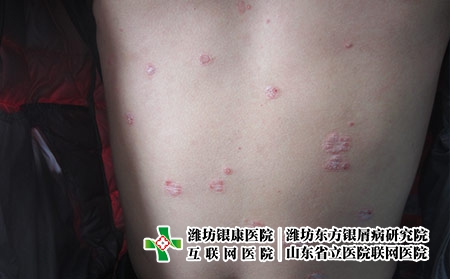 濰坊治療牛皮癬的外用藥有哪些，牛皮癬外用什么藥